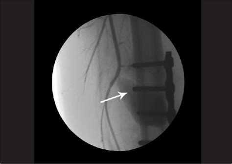 Figure 2 from Management of Iatrogenic Rupture of Profunda Femoris Artery after Femoral Fracture ...