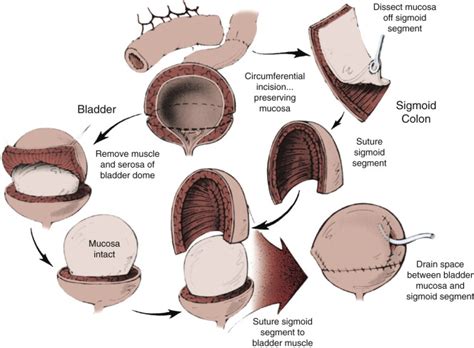 Spermatocelectomy | Abdominal Key