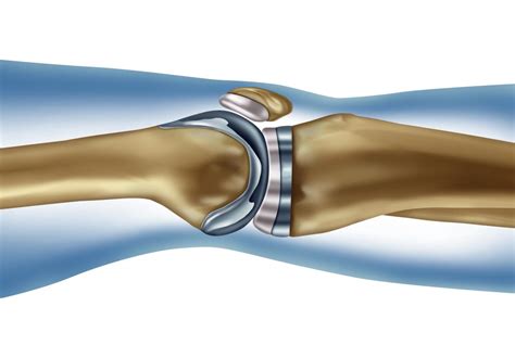 Hip, knee replacement for osteoarthritis raises risk of heart attack