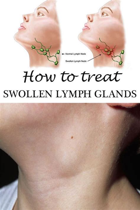 Swollen Lymph Nodes Causes Diagnosis And Treatment