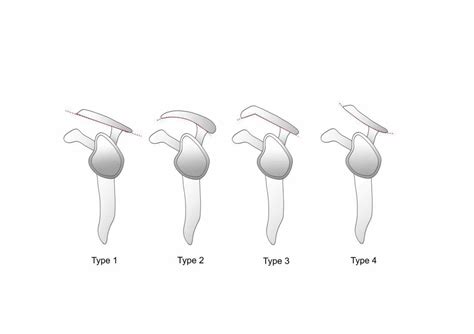 Cureus | Relationship Between Acromial Anatomy and Rotator Cuff Tears in Saudi Arabian Population