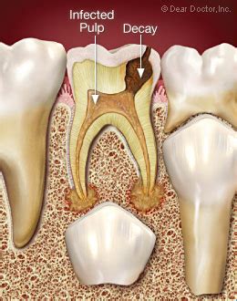 Figuring Out What Is Wrong - Root Canal Treatment For Children