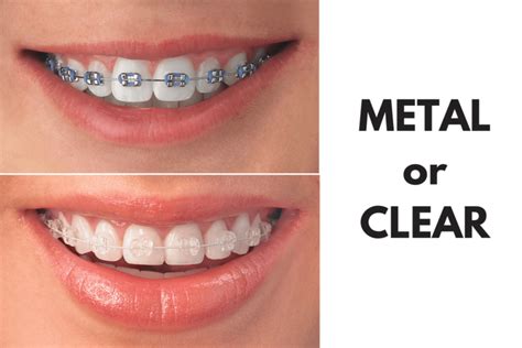 Clear Braces Vs. Metal Braces - Which One Is Right For You - DemotiX