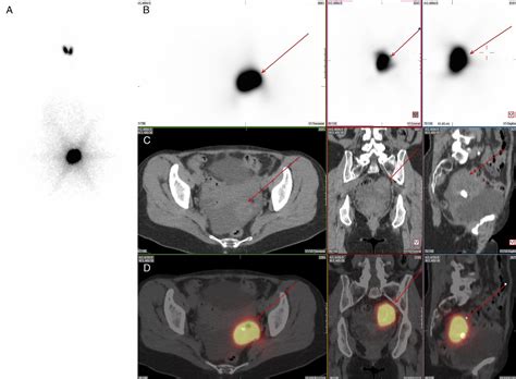 Struma Ovarii With Hyperthyroidism : Clinical Nuclear Medicine