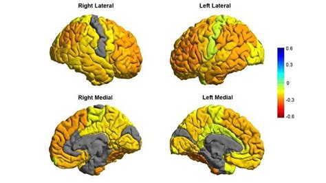 MRI Study of Bipolar Sufferers Reveals Structural Differences ...