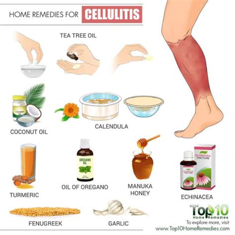 Home Remedies for Cellulitis | Top 10 Home Remedies