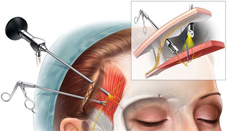 No place for Migraine Surgery (American Headache Association explained ...