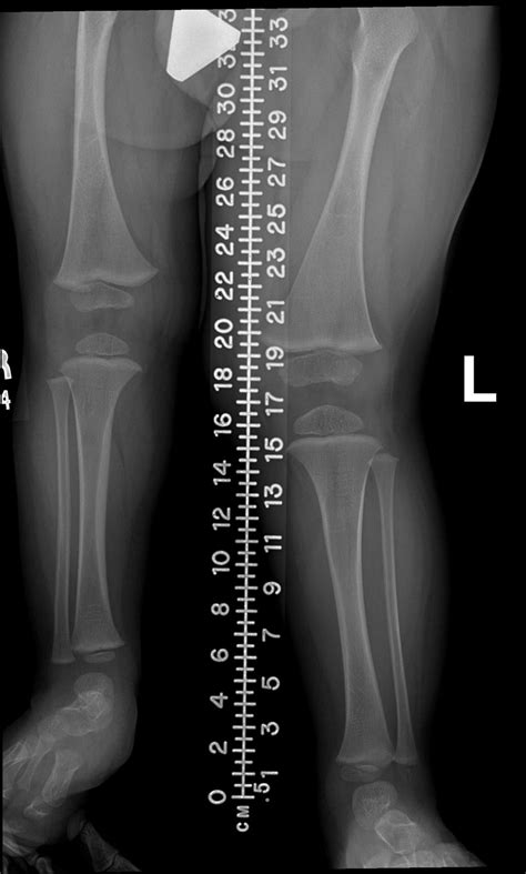 Beckwith-Wiedemann Syndrome - Pediatrics - Orthobullets