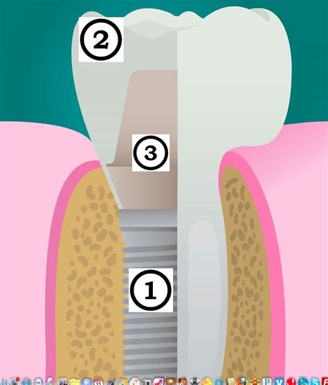 Ask For Customized Abutment For Your Dental Implant | Ask For ...