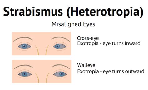 Treating Adult Strabismus - Ophthalmologists for Adult Strabismus