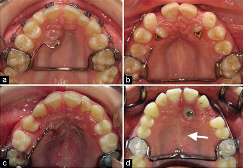 Orthodontic management of impacted maxillary canines - APOS Trends in Orthodontics