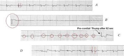 Precordial Thump - For Asystole? - ECG Strips | Paramedicine 101