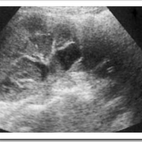 Ultrasound images of Pyonephrosis - Radiology Imaging