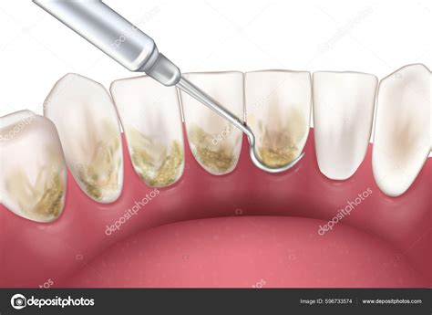 Periodontal Scaling Root Planing Oral Hygiene Conventional Periodontal Therapy Medically Stock ...