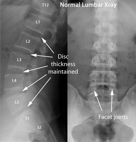 Lumbar Normal X-Ray | Radiology imaging, Medical anatomy, Radiology