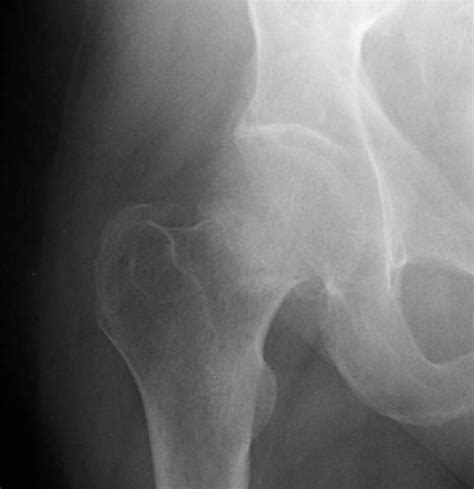 Femoral Neck Fractures - Trauma - Orthobullets