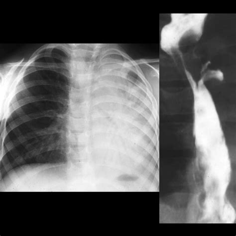 Esophageal Bronchus | Pediatric Radiology Reference Article | Pediatric ...