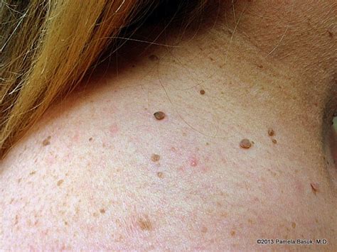 Skin Tags – BASUK DERMATOLOGY