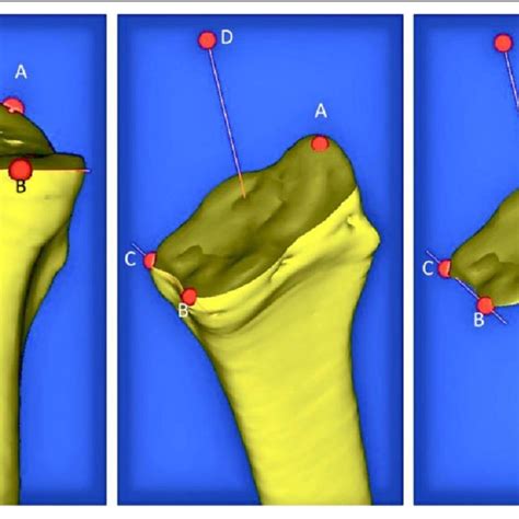 Morphological patterns of the sigmoid notch: (a) S-type notch, (b)... | Download Scientific Diagram