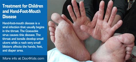 Hand Foot And Mouth Disease Rash Treatment