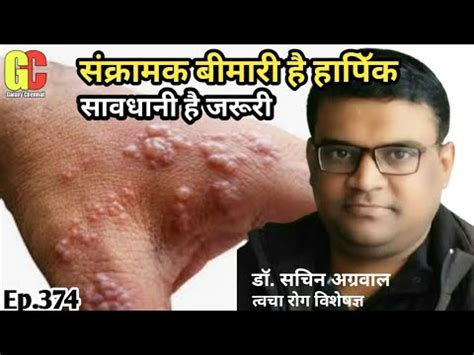 हरपीज: लक्षण, कारण और उपचार-Harpies Disease in Hindi | हर्पीस के उपाय व ...