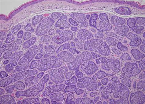 Cylindromas (Benign neoplasm of skin) - Dermatology Advisor