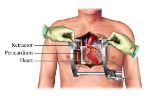 December CCU: Knife or the needle that is the question? Pericardiocentesis vs Pericardial Window ...