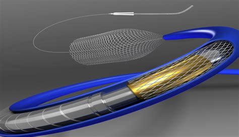 FDA Approves Pipeline Flex Diversion Device for Aneurysm