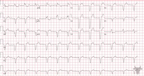 Left Bundle Branch Block | ECG Stampede