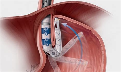 Transoral Incisionless Fundoplication (TIF) North Dallas & Plano TX - Kedia