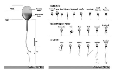 So Your Sperm Morphology is Low - Should You Be Worried? - Fertility ...