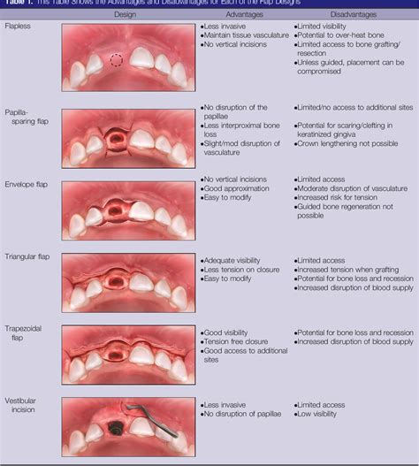 Considerations for Incision and Flap Design With Implant Therapy in the ...