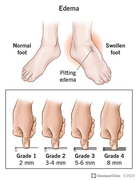 Top 8 swelling in legs and feet 2022