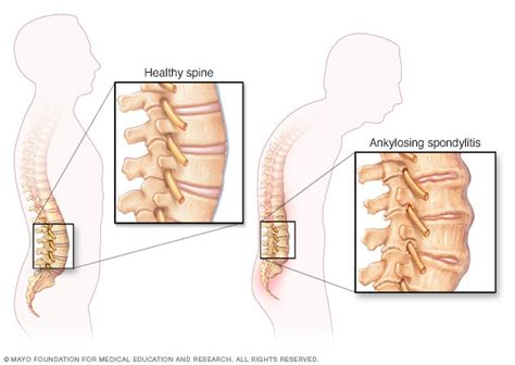 Ankylosing spondylitis - Symptoms and causes - Mayo Clinic