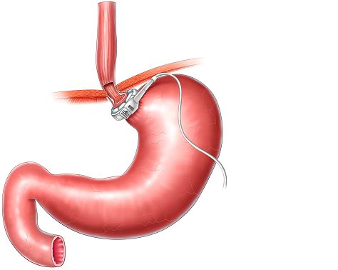 Lap Band Surgery - Basic Info and Benefits | Universal Health Care