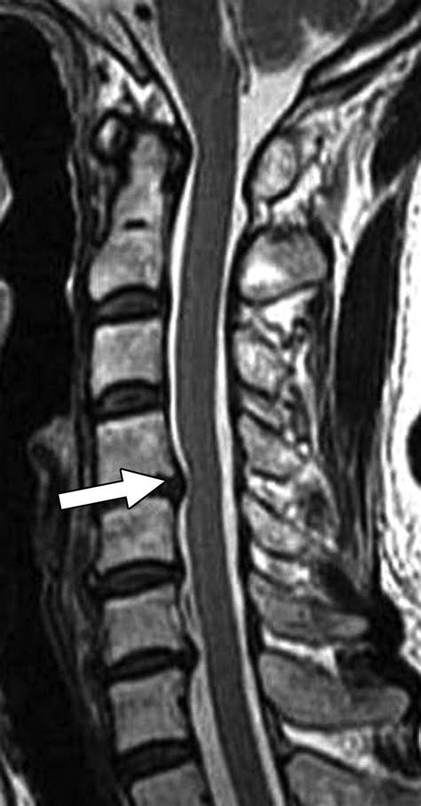 Spinal Stenosis Mri