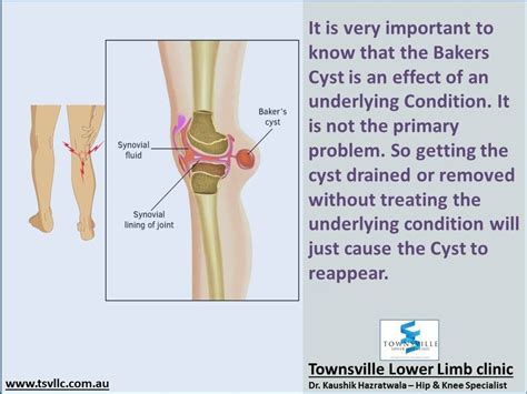 Baker's Cyst, Knee Replacement, Perfect Life, Conditioner, Feelings