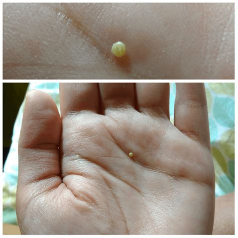 Got this from a pimple in my ear. I get this almost yearly and it always does this. It's so ...