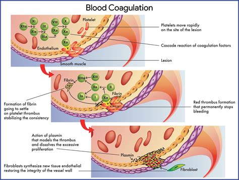 Hemophilia Nursing Care Planning and Management Study Guide - Nurseslabs