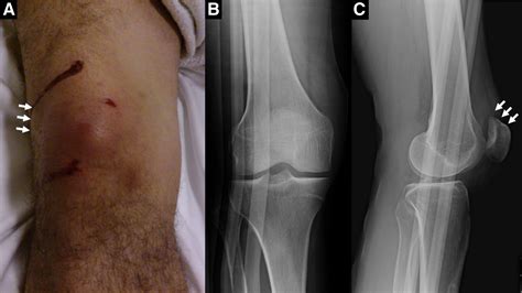 Closed Emergency Department Reduction of a Superior Patellar ...