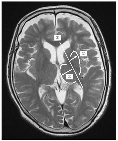 Putamen Atrophy Is a Possible Clinical Evaluation Index for Parkinson’s ...