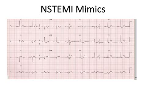 NSTEMI Vs STEMI On EKG