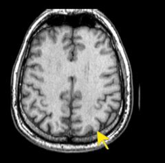 Harvard MRI Flashcards | Quizlet