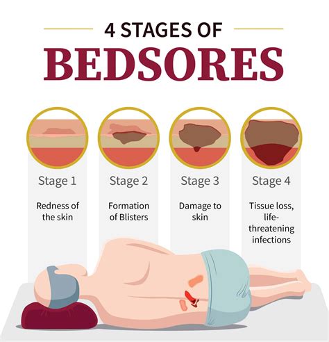 What are the 4 Stages of Bedsores? | Nursing Homes Abuse