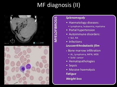 DIAGNOSIS AND MANAGEMENT OF MYELOPROLIFERATIVE NEOPLASMS