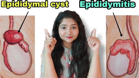 epididymal cyst | epididymitis treatment | Scrotal pain | - YouTube