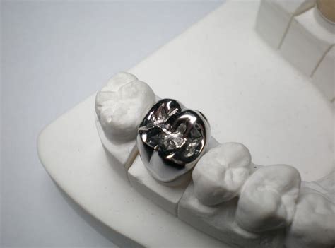 Stainless Steel Dental Crown | News | Dentagama