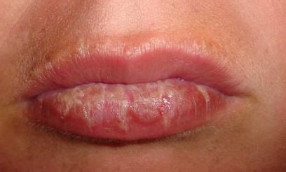 16 DIY Ways to Treat Sunburned Lips Easily Using Some Home Remedies ...