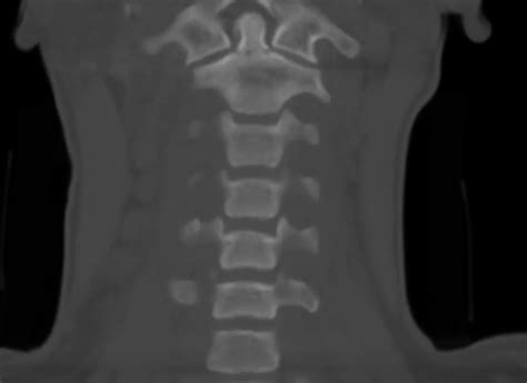 Unstable C-Spine Fractures