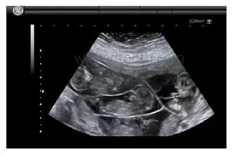 Quadruplets ultrasoundfake ultrasoundprankgag gift